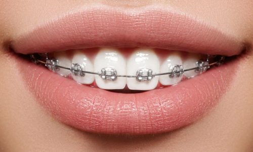 brackets-autoligables-providencia.jpg