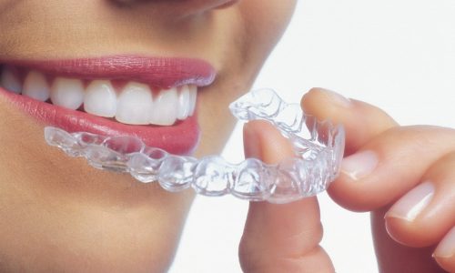 ventajas-invisalign3